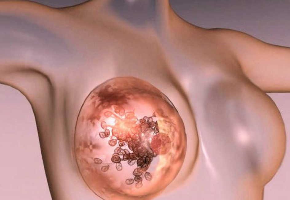 Возникновение рака груди