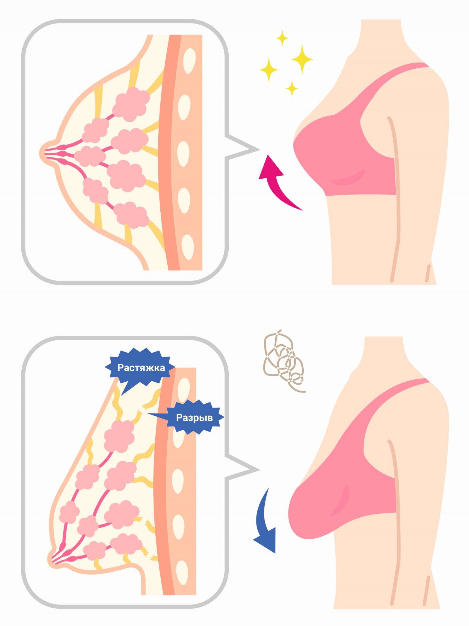 Подготовка к подтяжки груди